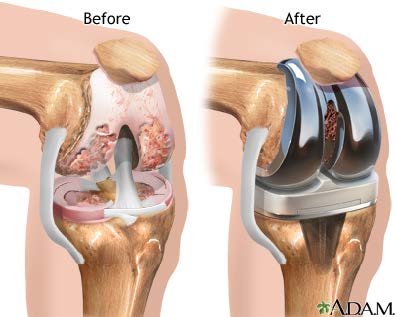 Knee joint replacement implant
