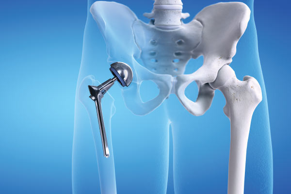 Hip joint implant components