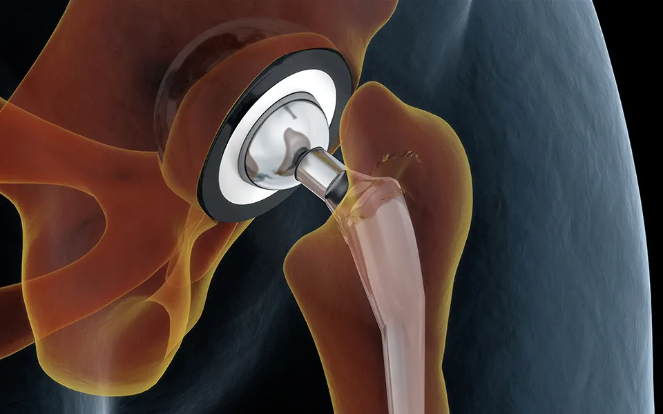 Hip Joint Implants