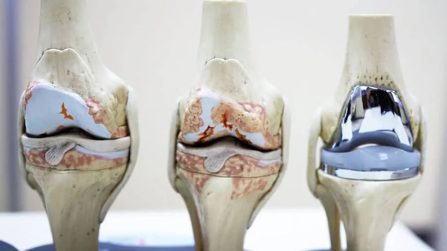 Knee Joint Implants